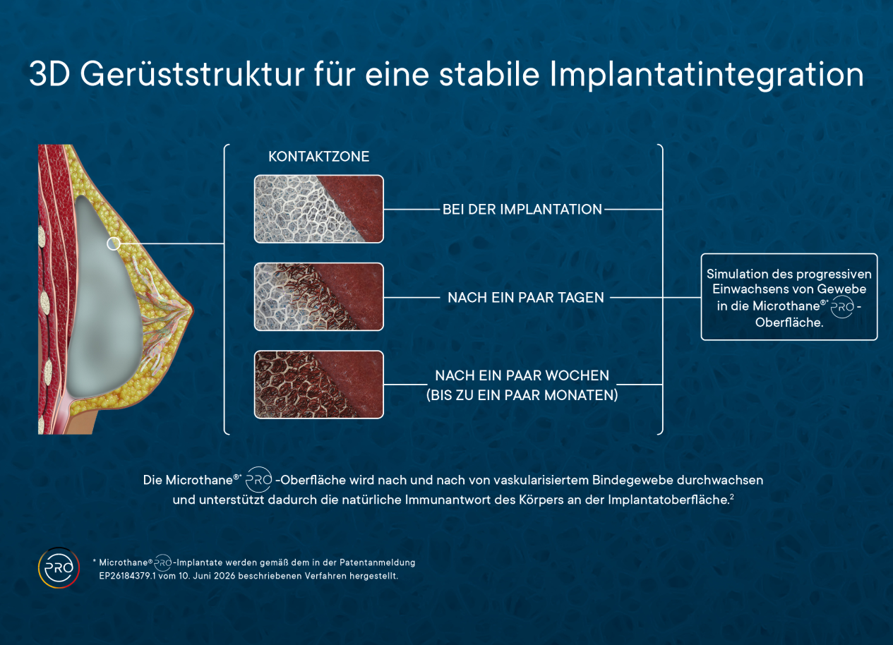 3D Grafik zeigt die Gerüststruktur für stabile Implantatintegration mit verschiedenen Phasen des Gewebeeinwachsens in die Microthane-Oberfläche.