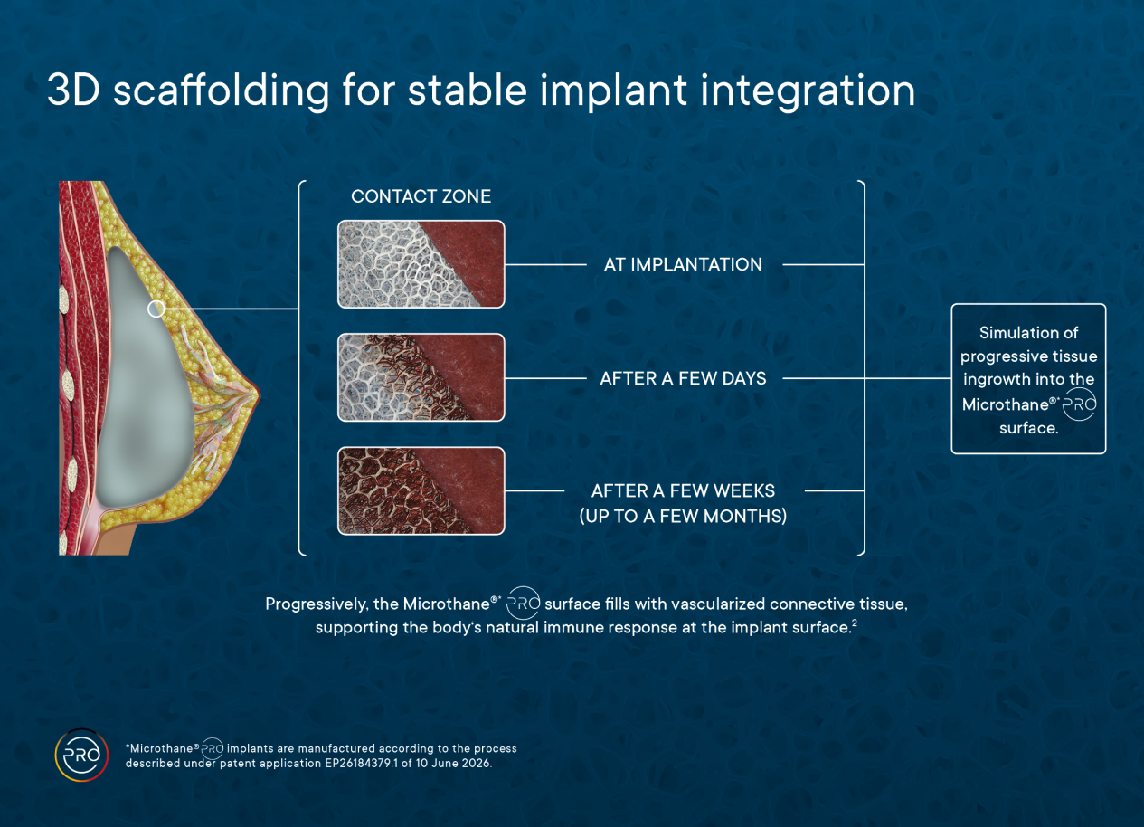 3D-Darstellung eines Implantats mit einem schematischen Überblick über den Integrationsprozess des Microthane™-Implantats über verschiedene Zeiträume.